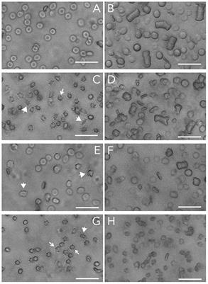 The Relationship Between Aggregation and Deformability of Red Blood Cells in Health and Disease